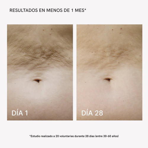 RF Tratamiento Flacidez Corporal